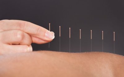 Dry needling
