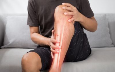 Fracture de fatigue chez les sportifs : comprendre, prévenir et soigner 